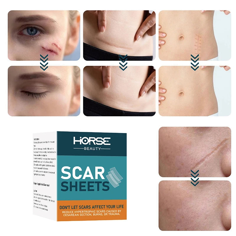 HORSE Silicone Gel Skin Patch Silicone Wound Repair Scar Patches Silicone Scar Patch Skincare Tools 2025